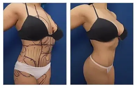 Before and after photos of a woman who had a tummy tuck in West Hollywood.