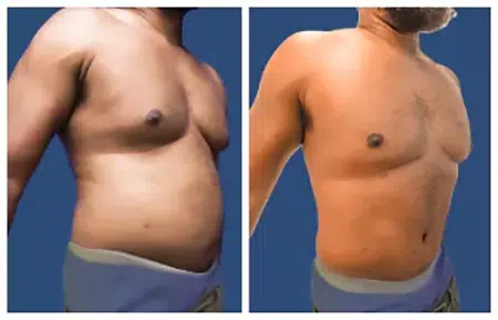 Before and after images of a tummy tuck in West Hollywood.