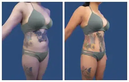 Before and after pictures of a woman in West Hollywood with tattoos.