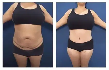 Before and after photos of a tummy tuck procedure in West Hollywood.