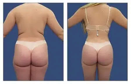 Before and after pictures of a woman's butt following liposuction in West Hollywood.