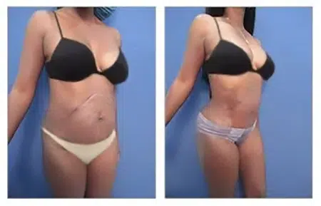 Before and after photos of a tummy tuck in West Hollywood.