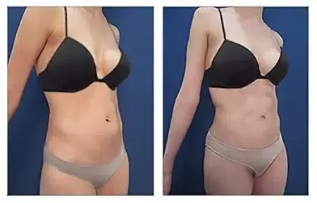 A collage of a woman wearing a garment undergoing liposuction in West Hollywood.