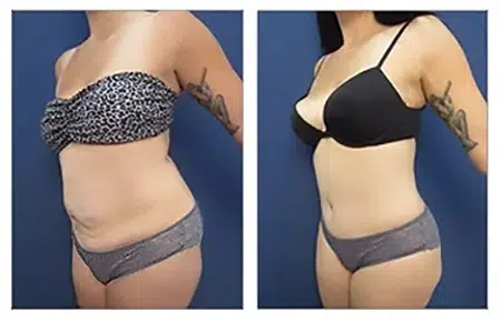 Before and after tummy tuck showcasing the results of liposuction in West Hollywood.