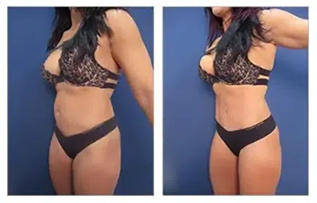 Before and after undergoing liposuction in West Hollywood, a woman is shown in a bikini.