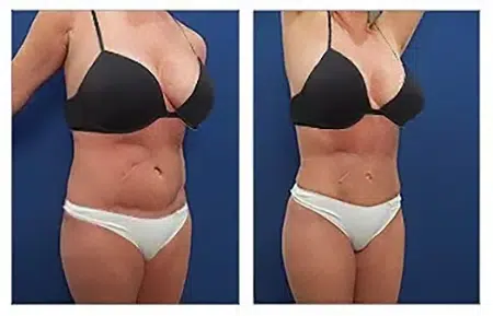 Before and after photos of a tummy tuck in West Hollywood.