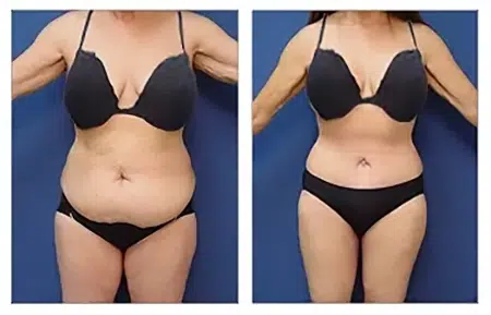 See the amazing transformation with a tummy tuck before and after procedure in West Hollywood.