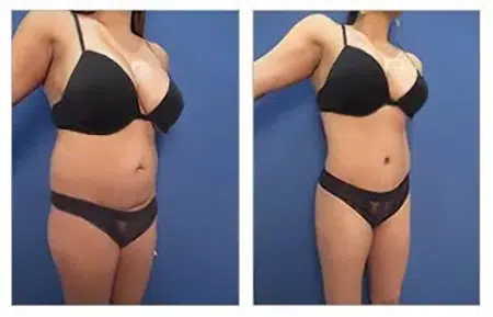 Before and after pictures of tummy tuck surgery in West Hollywood.