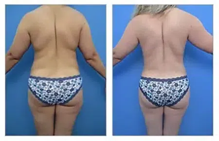 Before and after photos of tummy tuck and liposuction in West Hollywood.