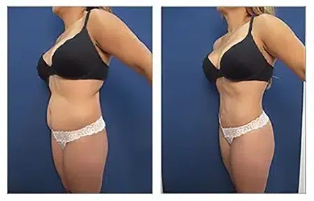 Before and after photos of a tummy tuck in West Hollywood.