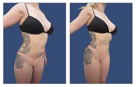 Before and after pictures of a woman with tattoos in West Hollywood.