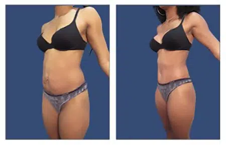 Before and after photos of a tummy tuck procedure in West Hollywood.