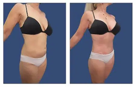 Before and after photos of tummy tuck procedure in West Hollywood.