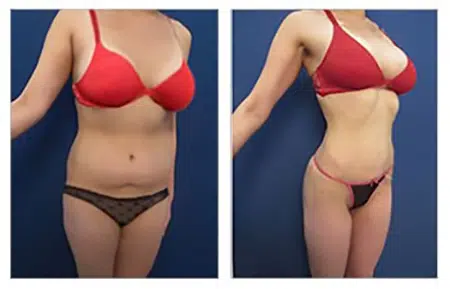 Before and after photos of a tummy tuck procedure in West Hollywood.