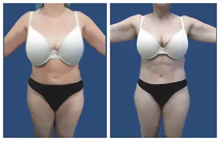 Before getting liposuction in West Hollywood, see the amazing results of a tummy tuck before and after.