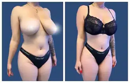 Before and after undergoing liposuction in West Hollywood, a woman's breasts display noticeable changes.