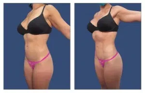 Liposuction Before & After