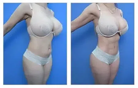 Two photos of a woman before and after breast augmentation in West Hollywood.