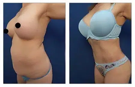 Before and after photos of a tummy tuck procedure in West Hollywood.