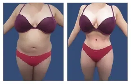 View before and after pictures of tummy tucks in West Hollywood.