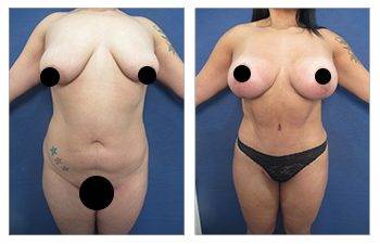 A woman's breast before and after High Definition Liposuction surgery.