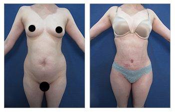 View impressive tummy tuck results before and after undergoing the procedure.