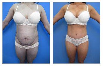 Tummy tuck before and after: everything you need to know.