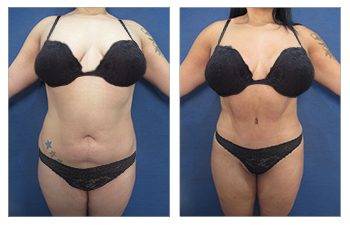 Before and after tummy tuck.