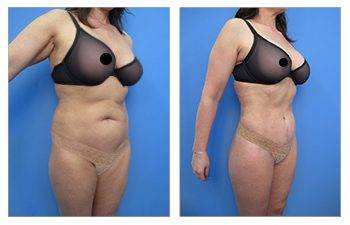 VASER High Definition Liposuction before and after.