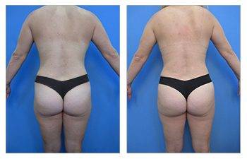 View a tummy tuck before and after transformation, ensuring a safe procedure with BBL.