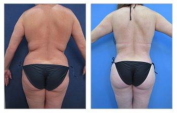 A woman in a bikini before and after liposuction following the Safe BBL Protocol.