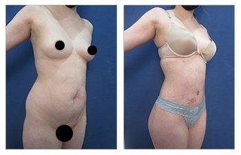 Before and after photos of a tummy tuck procedure, showcasing the effects on the abdomen.