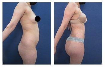 Before and after photos of a tummy tuck procedure, showcasing the results.