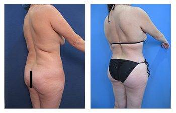 Safe BBL Protocol before and after tummy tuck.