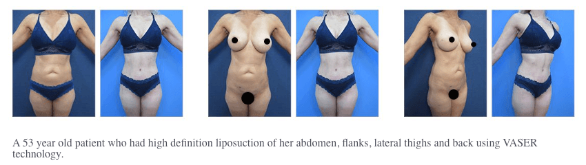 Laser Liposuction Cost is an important factor - but only one factor