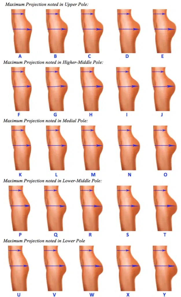 Brazilian Butt Lift Calculator LA-CA