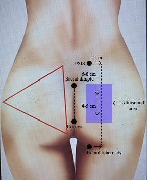 A diagram of a woman's body following the Safe BBL Protocol.