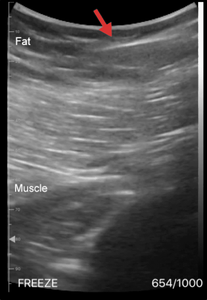 A close-up of an ultrasound following the Safe BBL Protocol.