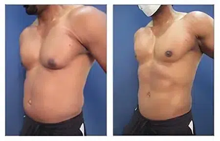 High Definition Abdominal Contouring - See remarkable before and after transformations!