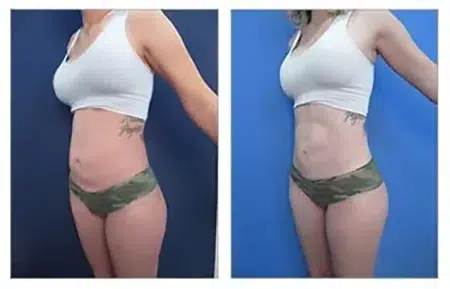 Liposuction Beverly Hills Before and After.