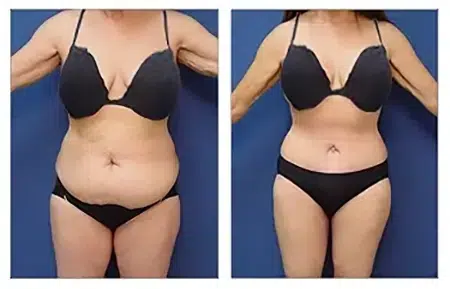 Liposuction Beverly HIlls Case Study.