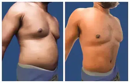 Liposuction for Gynecomastia