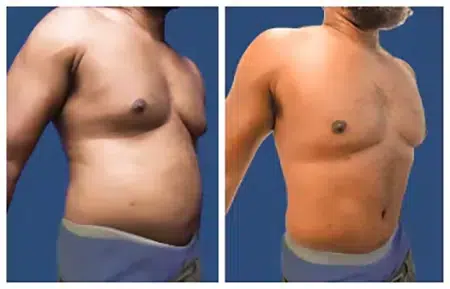 Liposuction Burbank Before and After.