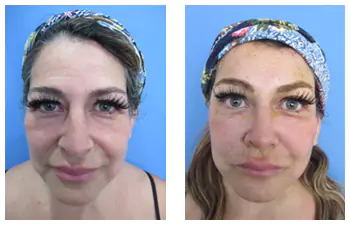 Attiva Radiofrequency Skin Treatment Before And After