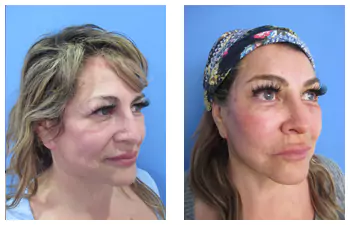 Attiva Radiofrequency Skin Treatment Before And After