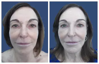 Attiva Radiofrequency Skin Treatment Before And After