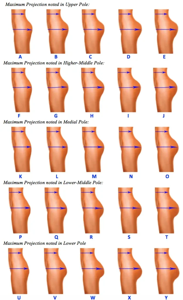 Brazilian Butt Lift vs Buttock Implant Calculator