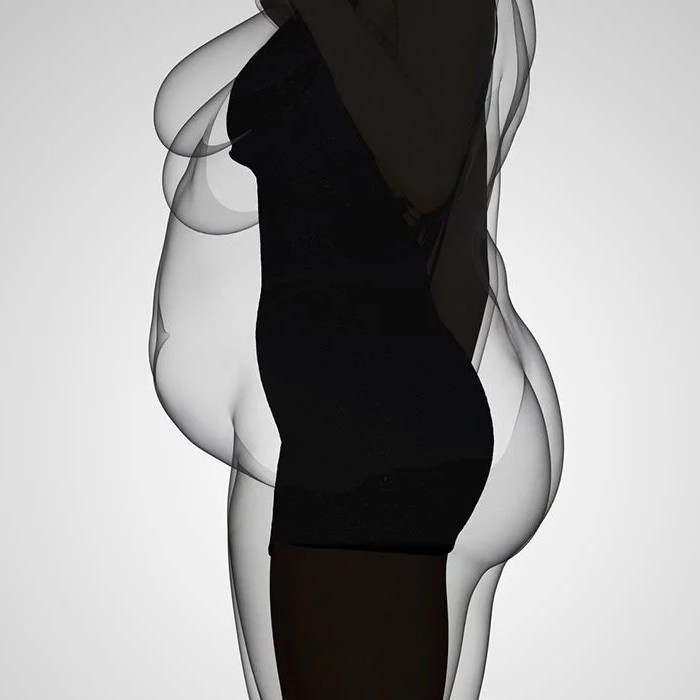 SurgiSculpt body contouring